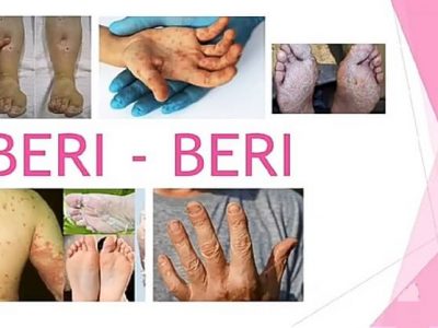 Beriberi symptoms | ‘बेरीबेरी’ आजार | लक्षणे वाढवू  शकतात ही कारणे – नक्की वाचा