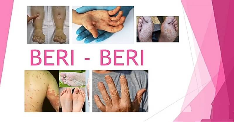 Beriberi symptoms and causes 