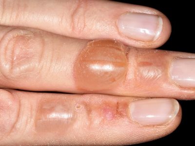 Blisters symptoms and causes | ‘गळू’ आजार | लक्षणे आणि उपचार – नक्की वाचा