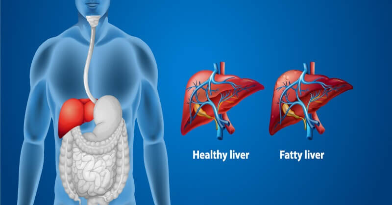 Fatty Liver Disease Signs