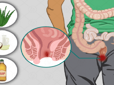 Health First | ‘फिशर’ जखम होण्याची कारणं कोणती? | उपचार कोणते? – नक्की वाचा