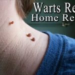 Home Remedies on Warts