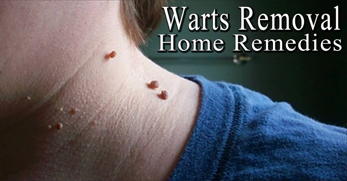 Home Remedies on Warts