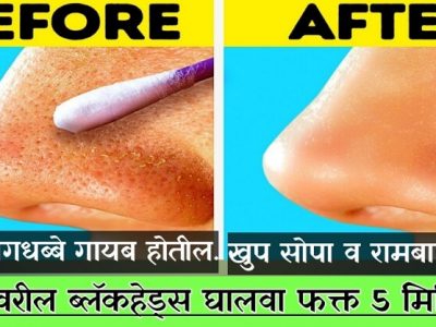 Health First | चेहऱ्यावरील ब्लॅकहेड्स घालवण्याचा घरगुती रामबाण उपाय – नक्की वाचा