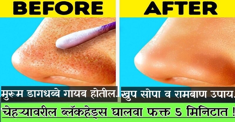 Home remedies for blackheads