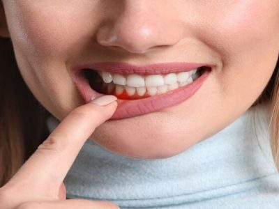 Health First | हिरड्यांच्या दुखण्यापासून लगेच मिळेल आराम | वाचा हे घरगुती उपाय