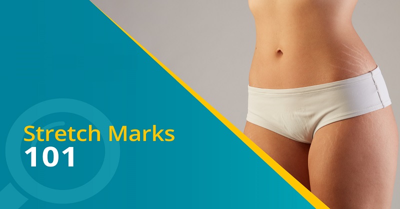 Home remedies on stretch marks