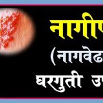 Home remedies on Nagin disease