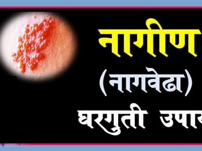 Nagin Disease | कशामुळे होतो ‘नागीण’ आजार? | लक्षणे आणि घगूती उपाय | नक्की वाचा