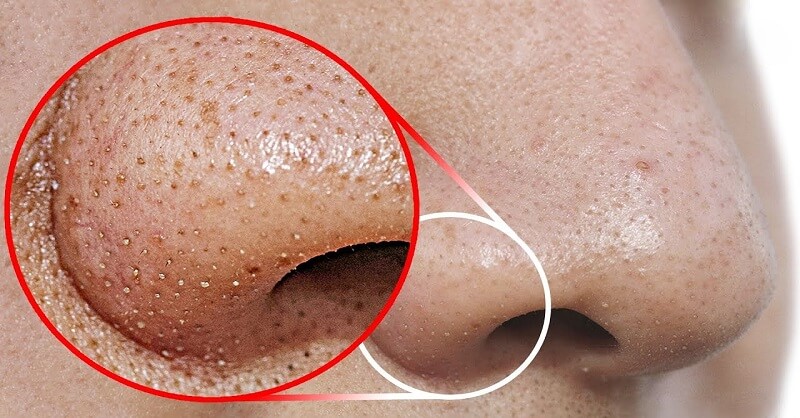 home remedies for nose blackheads