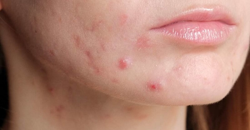 home remedies for removing pimples