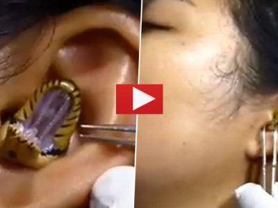 Viral Video | बापरे, मुलीच्या कानामध्ये साप गेला, डॉक्टरांची सुद्धा सापाला कानातून बाहेर काढताना होणारी कसरत कॅमेऱ्यात कैद