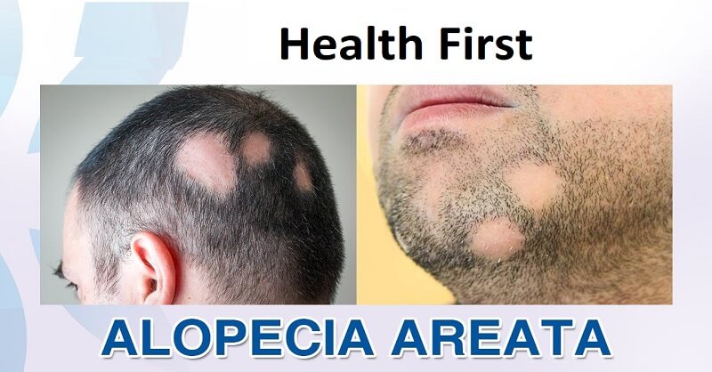 Alopecia Areata home remedies