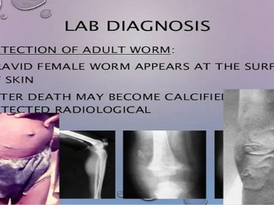 Dracunculus Medinensis symptoms | ‘नारू’ आजार ज्याची अनेकांनी माहिती नाही | लक्षणे व उपचार – नक्की वाचा