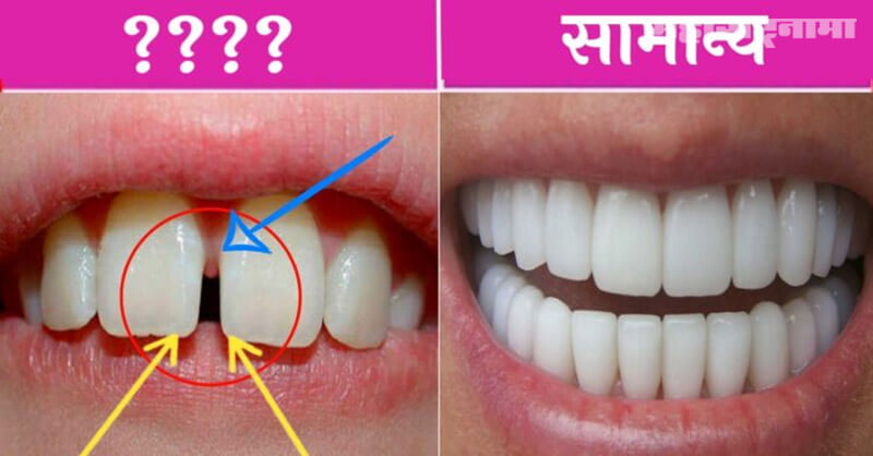 Gap Between Teeth, Health Fitness, Health Articles, Marathi News ABP Maza