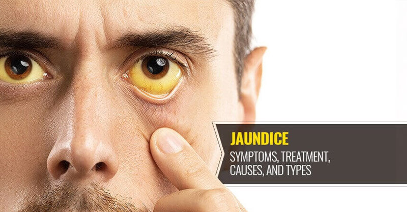 Home Remedies for Jaundice