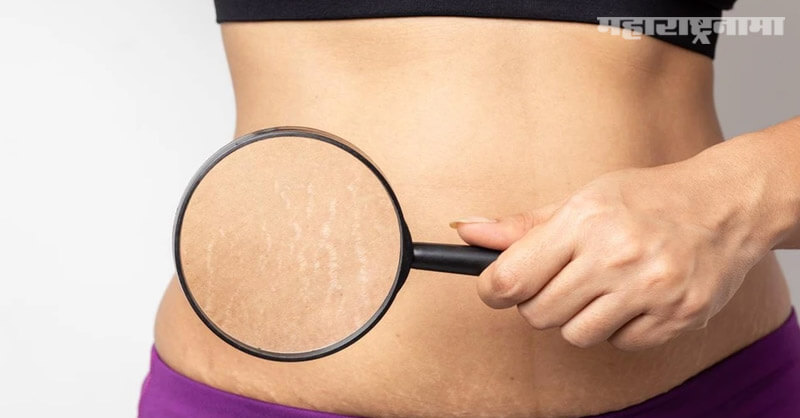 Stretch marks, weight loss, Health article
