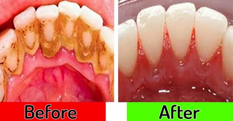 tooth plaque Home remedies